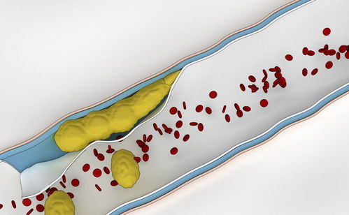 控制饮食降低坏血脂 健康投资与医疗费用节约的双赢策略